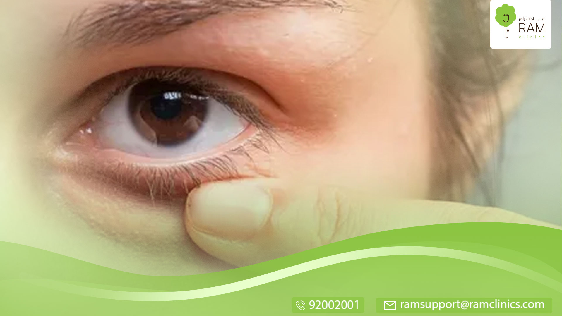 أسباب انتفاخ العين