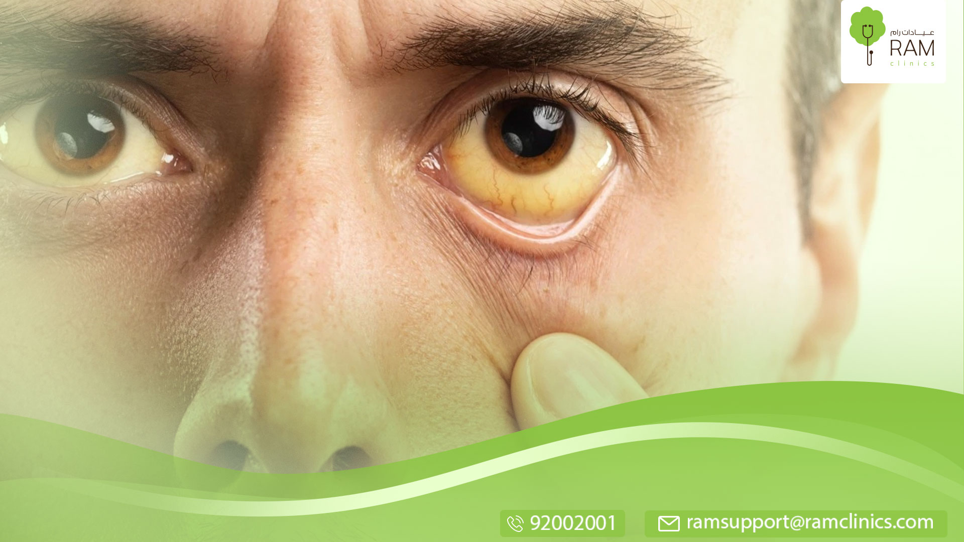 ما هو مرض متلازمة آشر