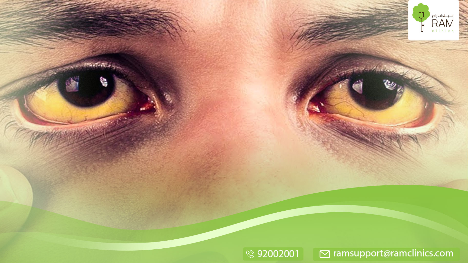 مرض اليرقان خطير