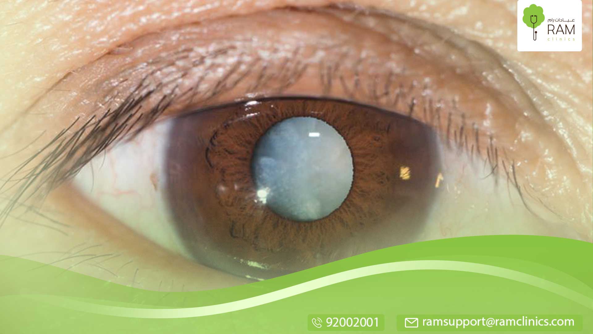 علاج اصفرار العين