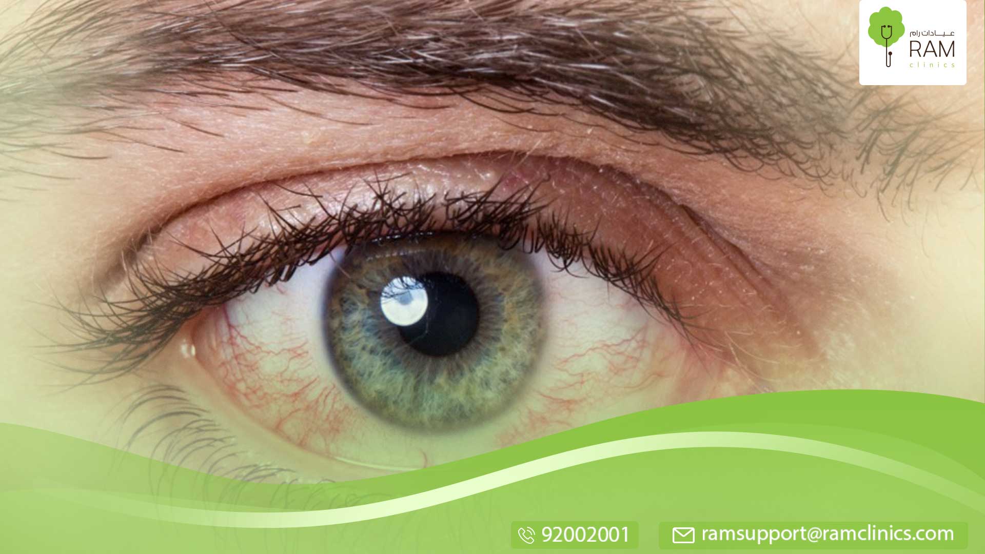 احمرار العين