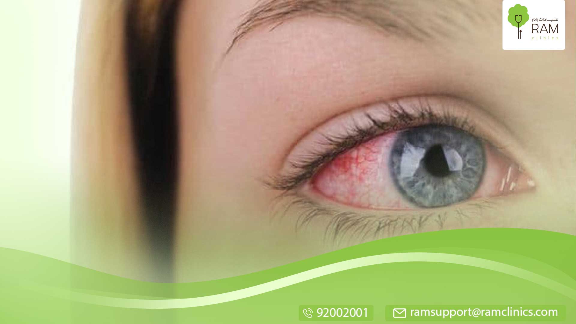 جفاف العيون