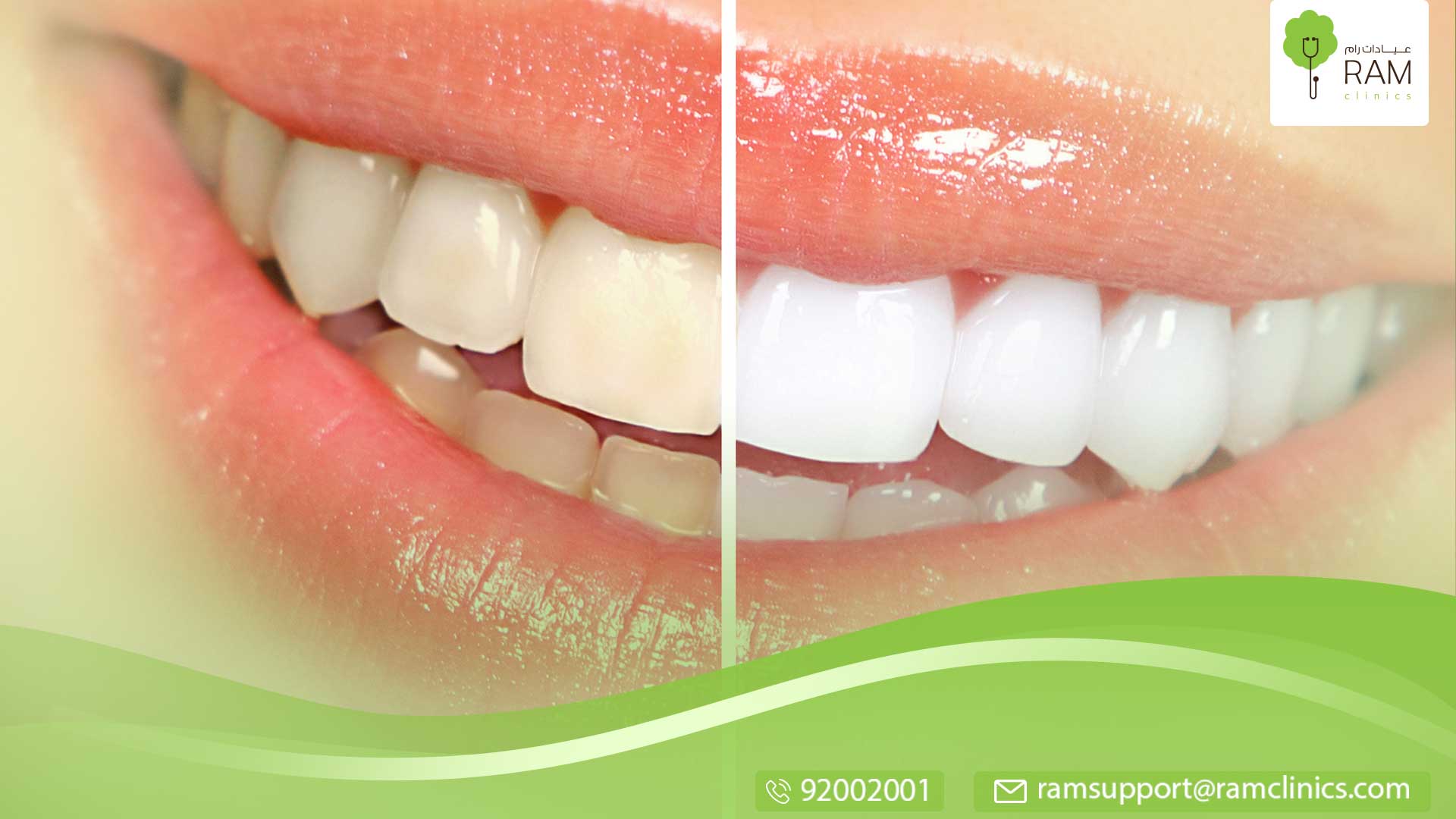 الأسنان عند لأطفال