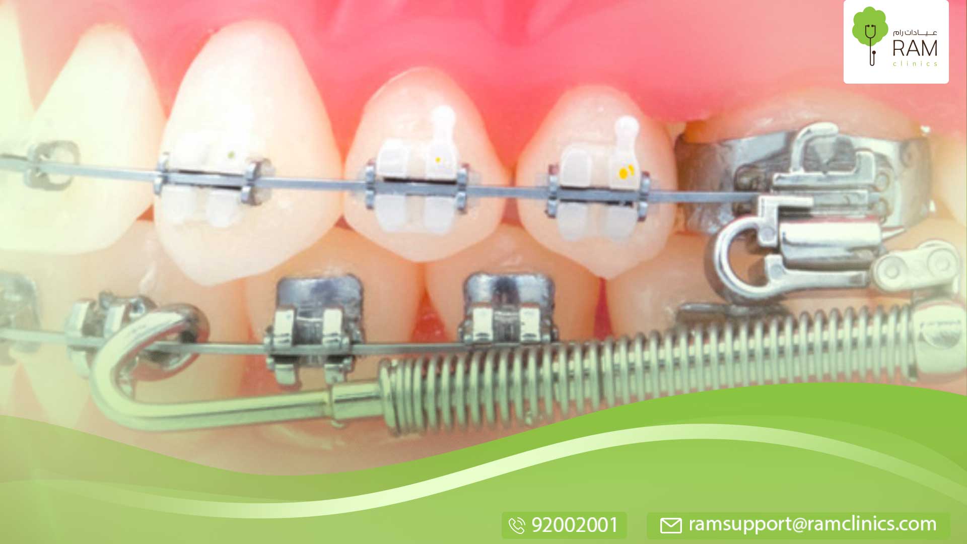 جراحة الفك السفلي
